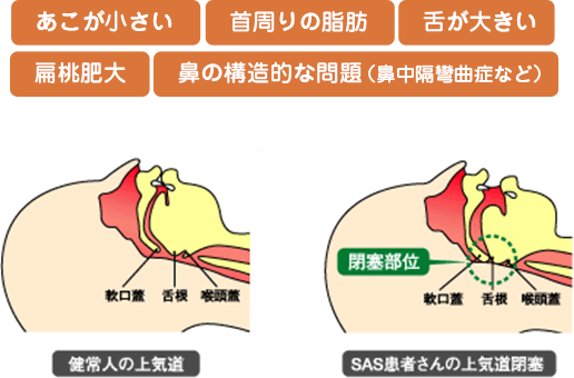 あこが小さい / 首周りの脂肪 / 舌が大きい / /扁桃肥大 / 鼻の構造的な問題（鼻中隔彎曲症など）