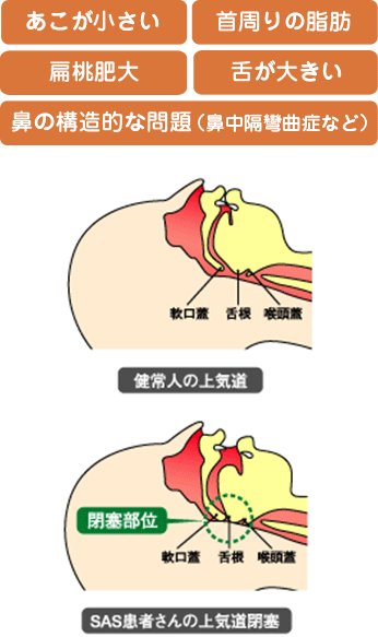 あこが小さい / 首周りの脂肪 / 舌が大きい / /扁桃肥大 / 鼻の構造的な問題（鼻中隔彎曲症など）